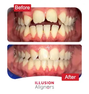 Illusion Aligners